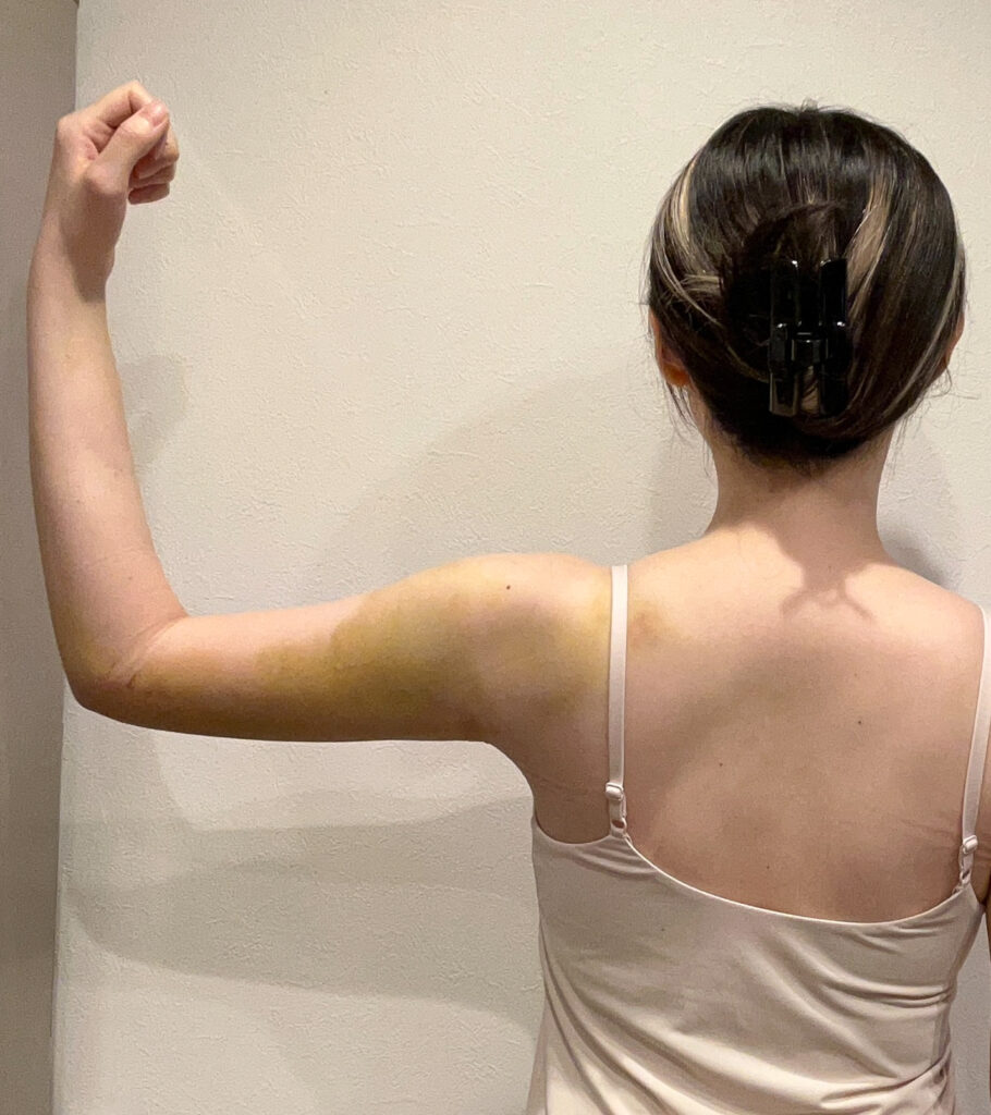 二の腕の脂肪吸引