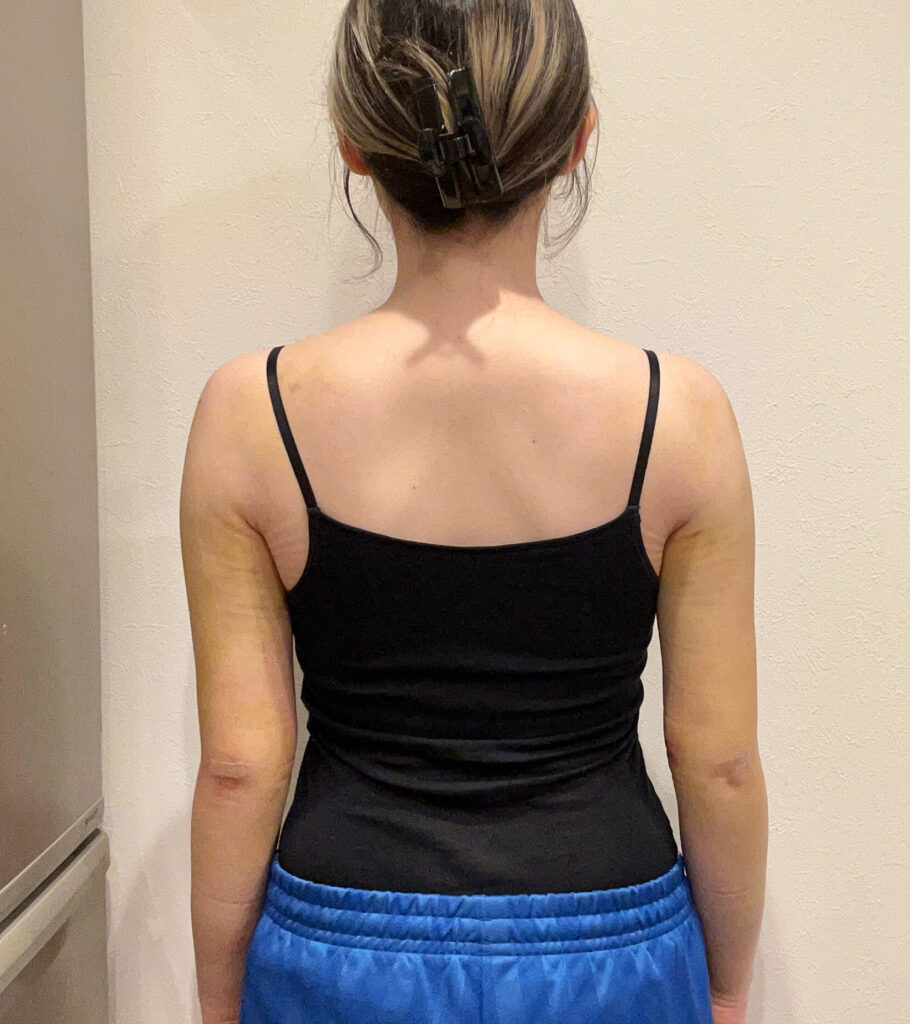 二の腕の脂肪吸引