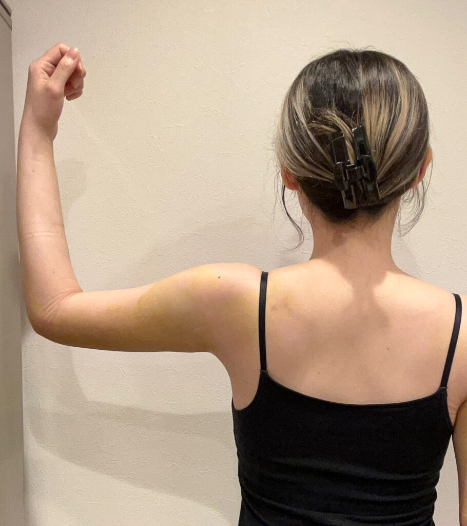 二の腕の脂肪吸引