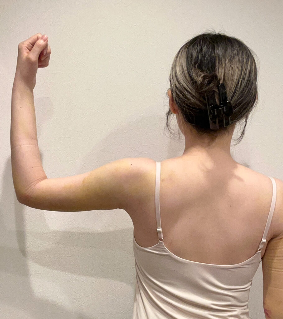 二の腕の脂肪吸引