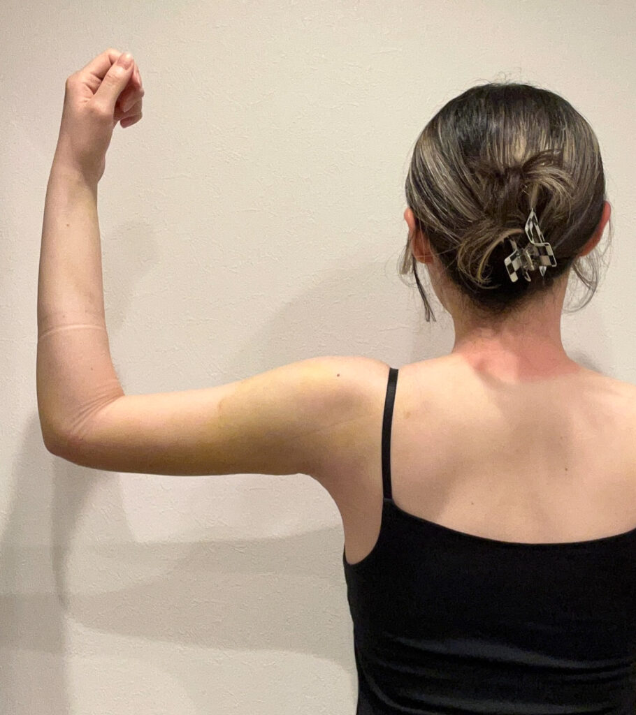 二の腕の脂肪吸引