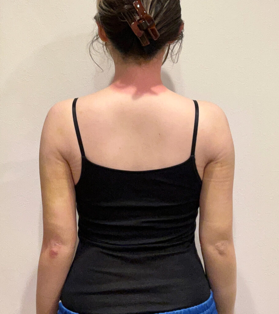 二の腕の脂肪吸引