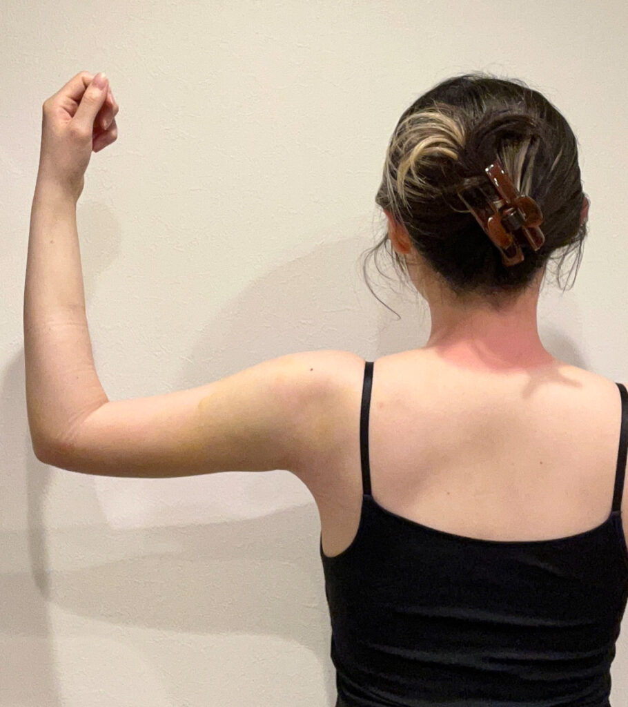 二の腕の脂肪吸引