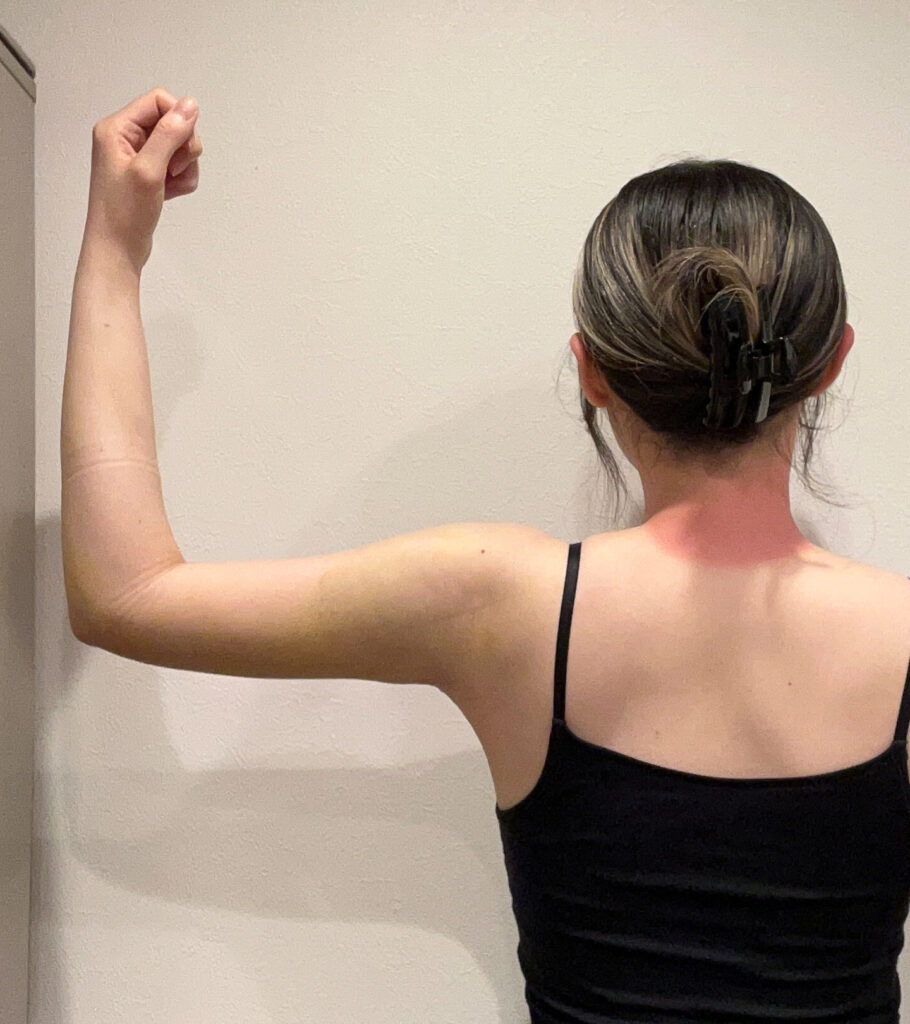 二の腕の脂肪吸引