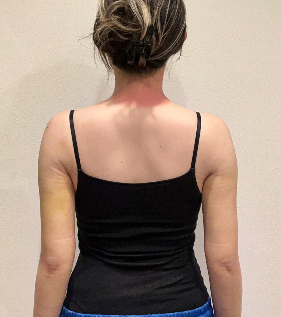 二の腕の脂肪吸引