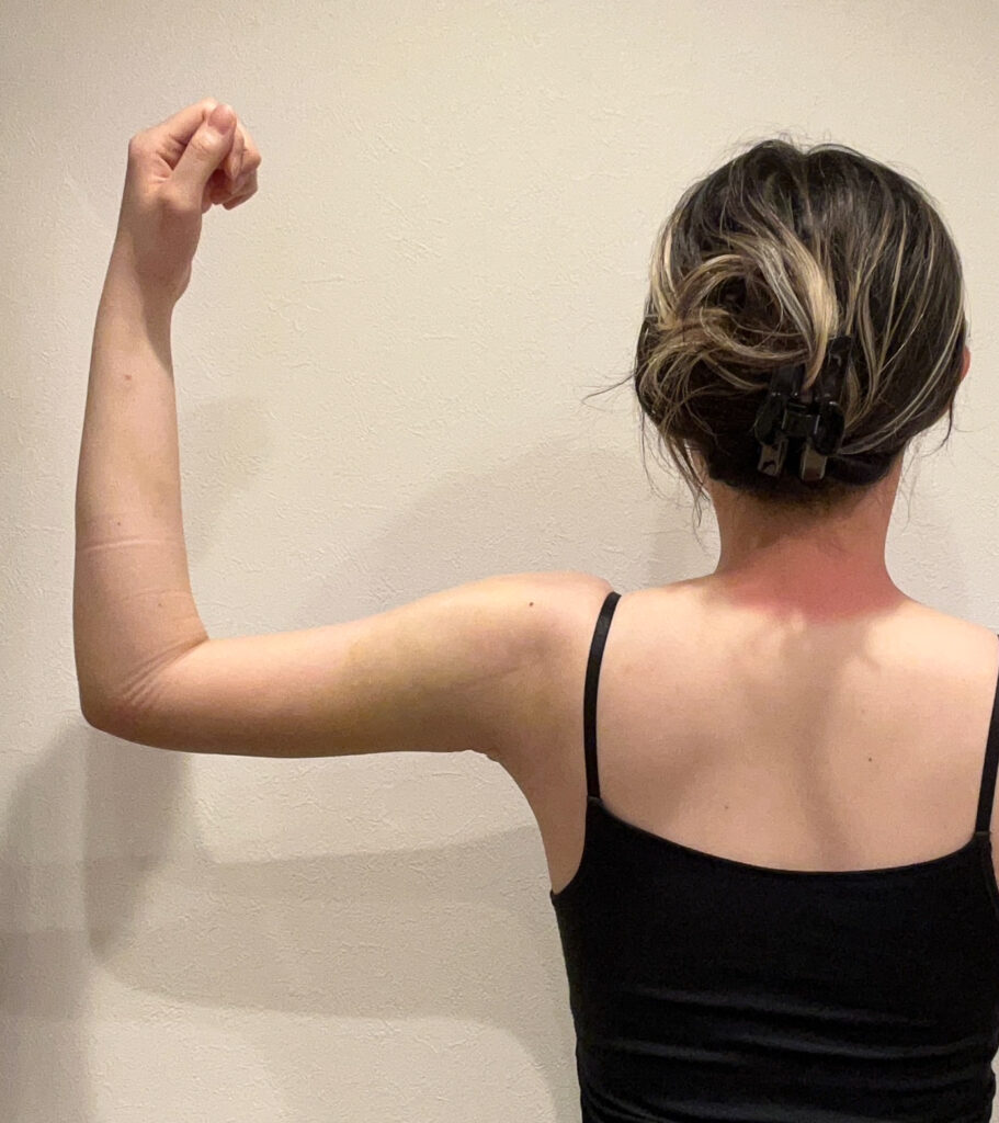 二の腕の脂肪吸引