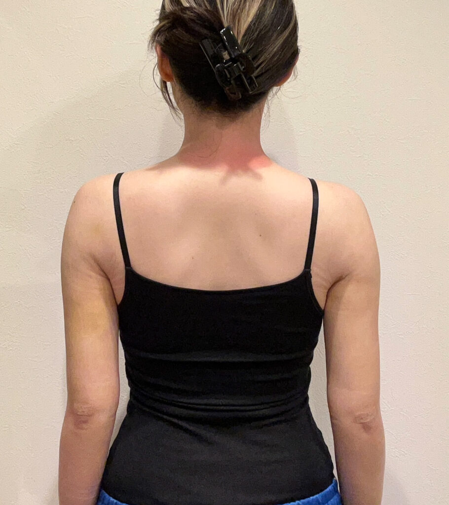 二の腕の脂肪吸引