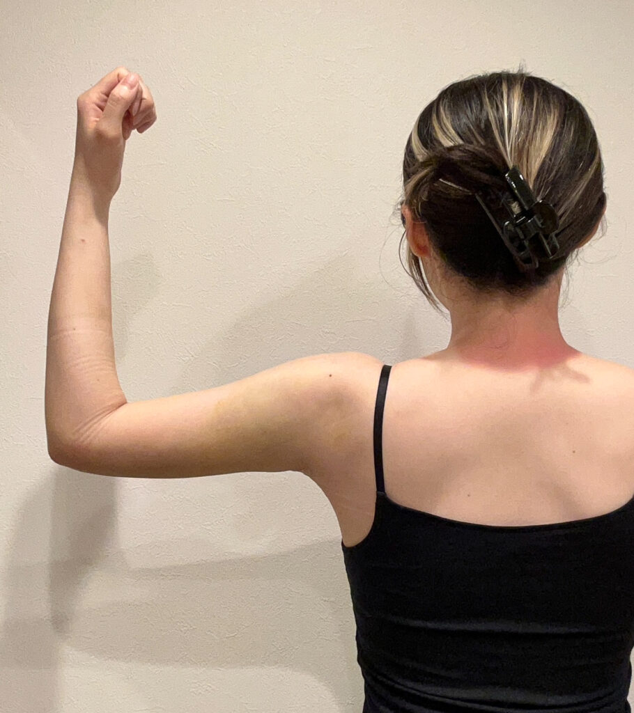 二の腕の脂肪吸引