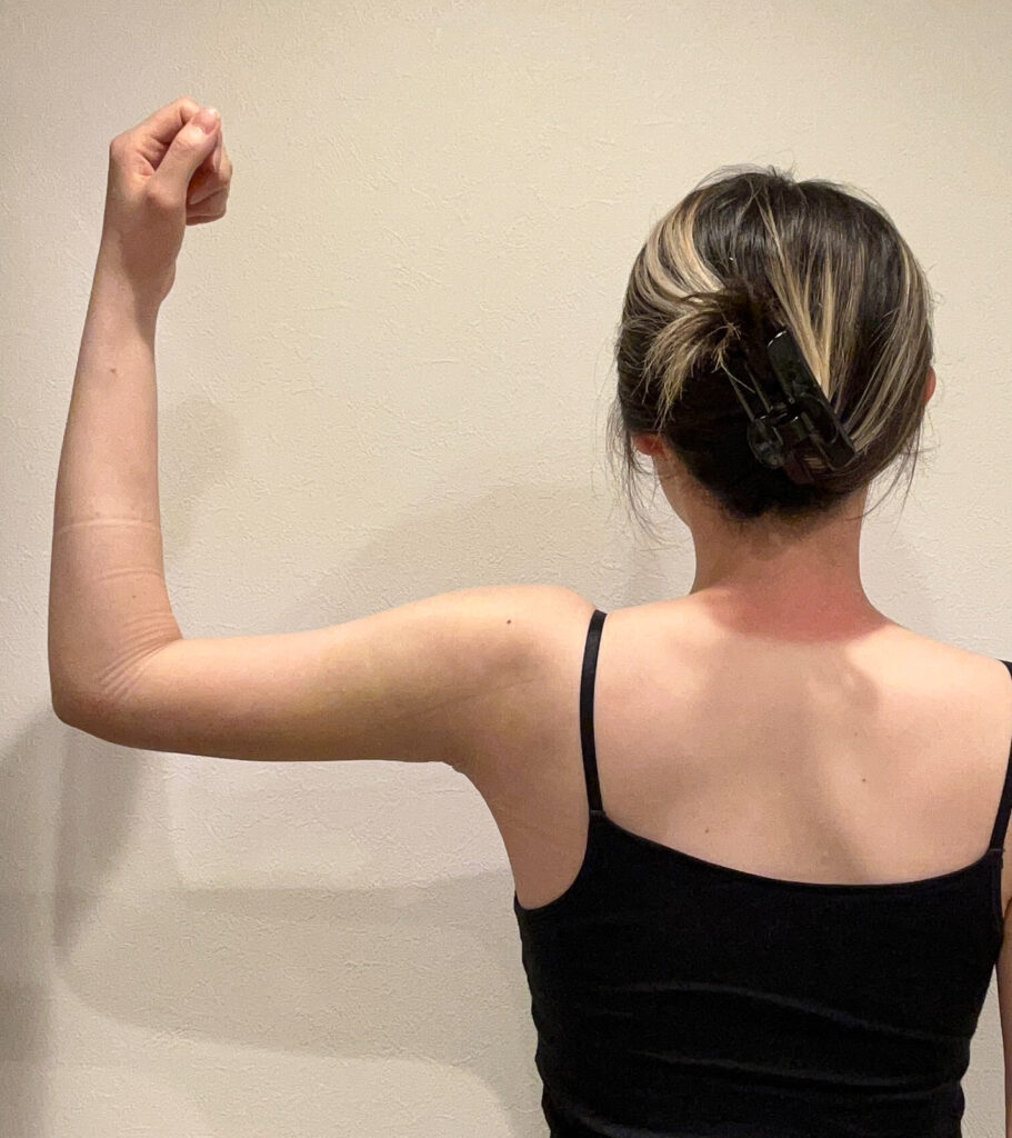 二の腕の脂肪吸引