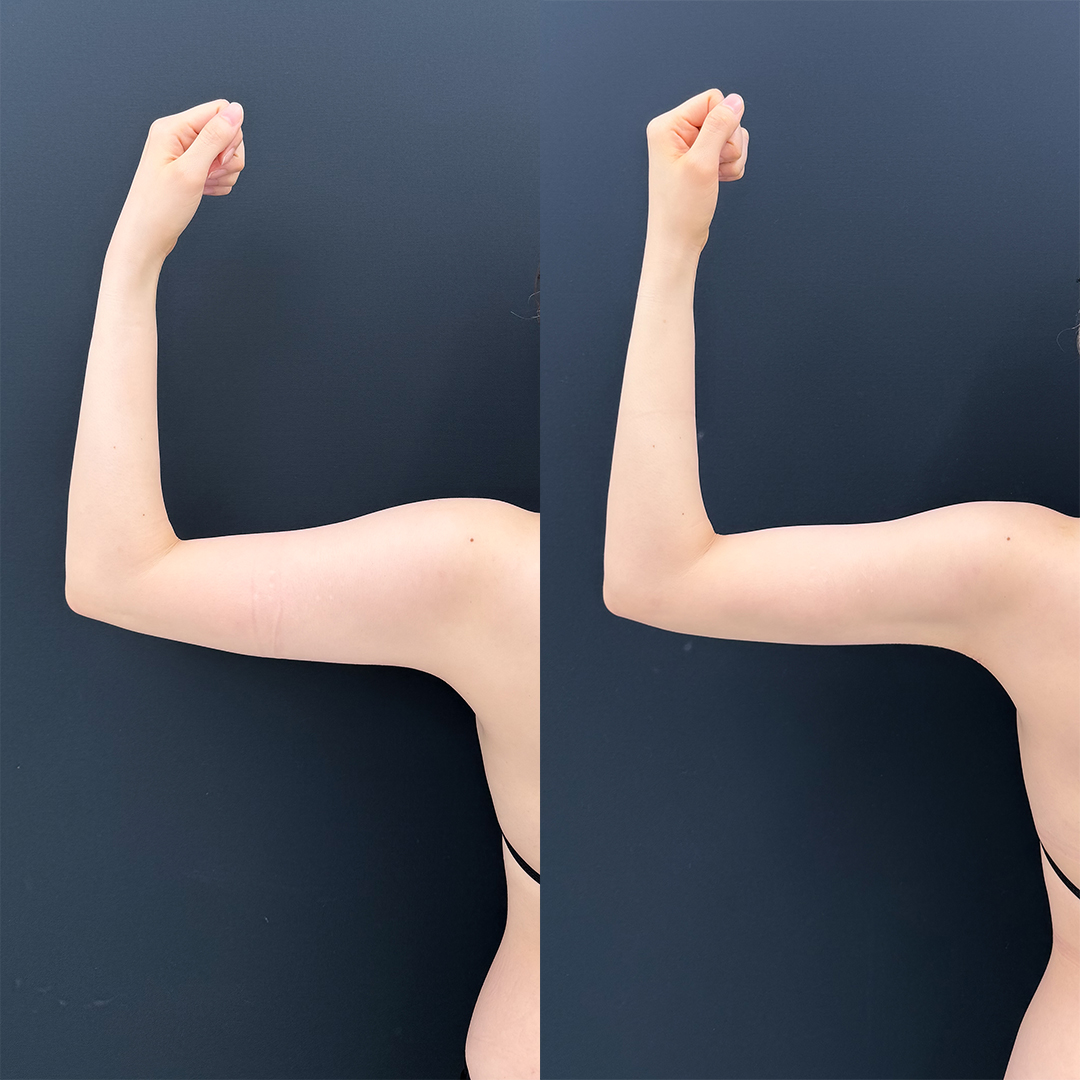 https://purelys-tokyo-clinic.com/wp/wp-content/uploads/2026/01/arm-Liposuction_Case-No.378.jpg