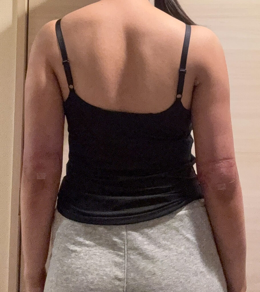 二の腕の脂肪吸引