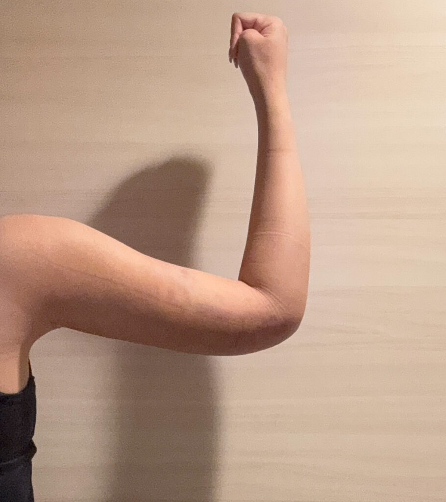 二の腕の脂肪吸引