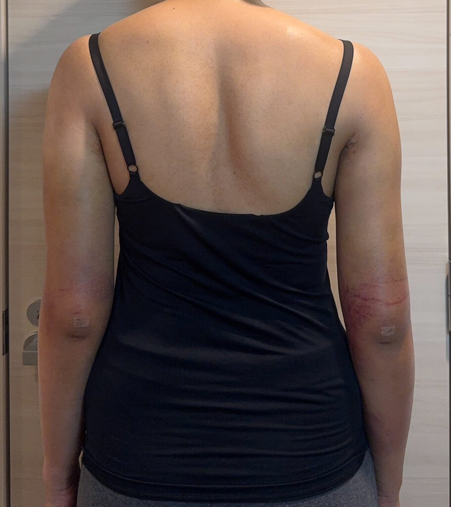 二の腕の脂肪吸引