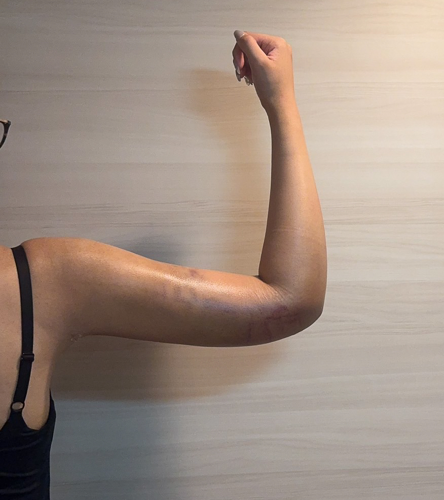 二の腕の脂肪吸引