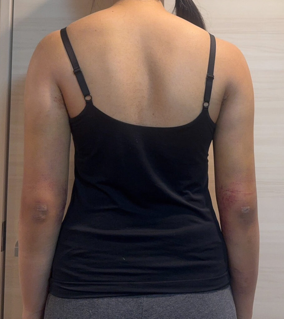 二の腕の脂肪吸引