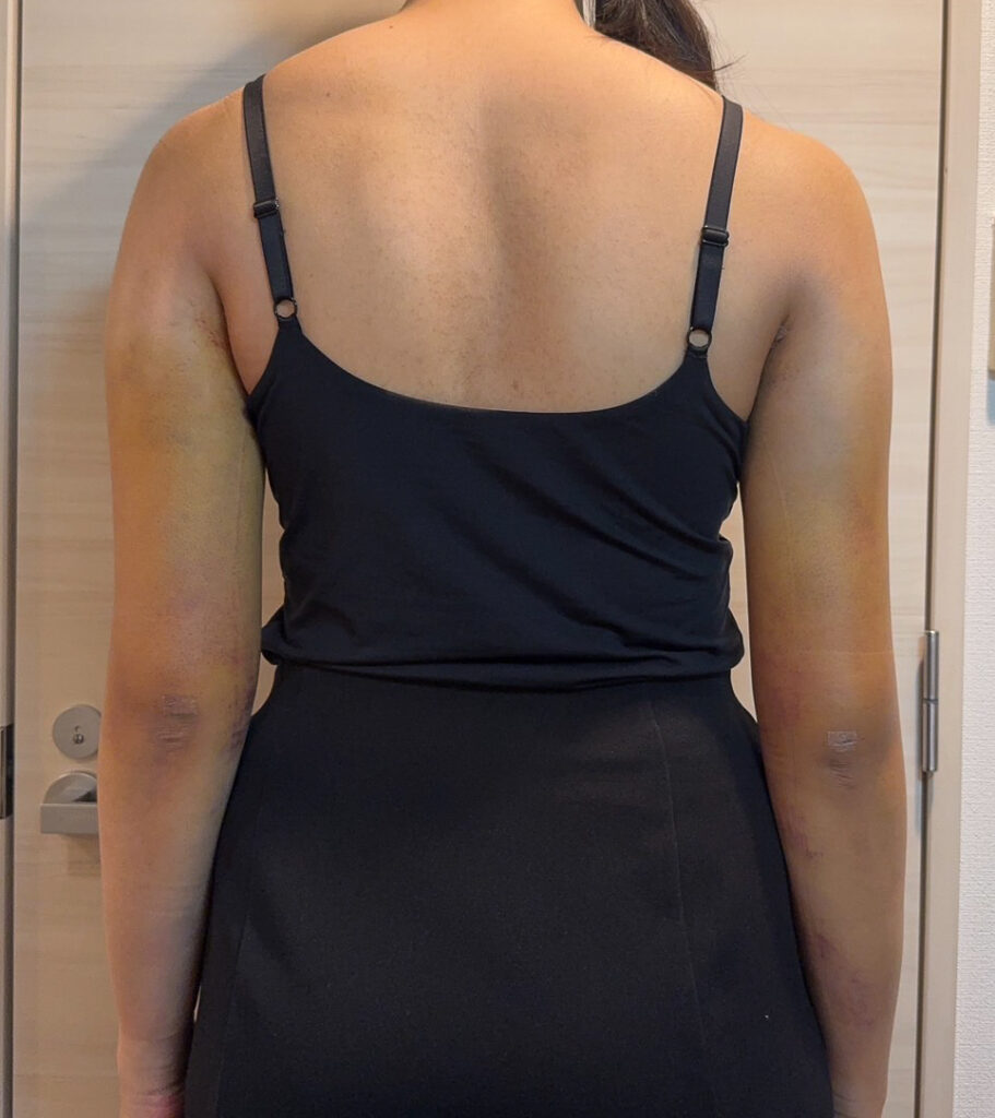 二の腕の脂肪吸引