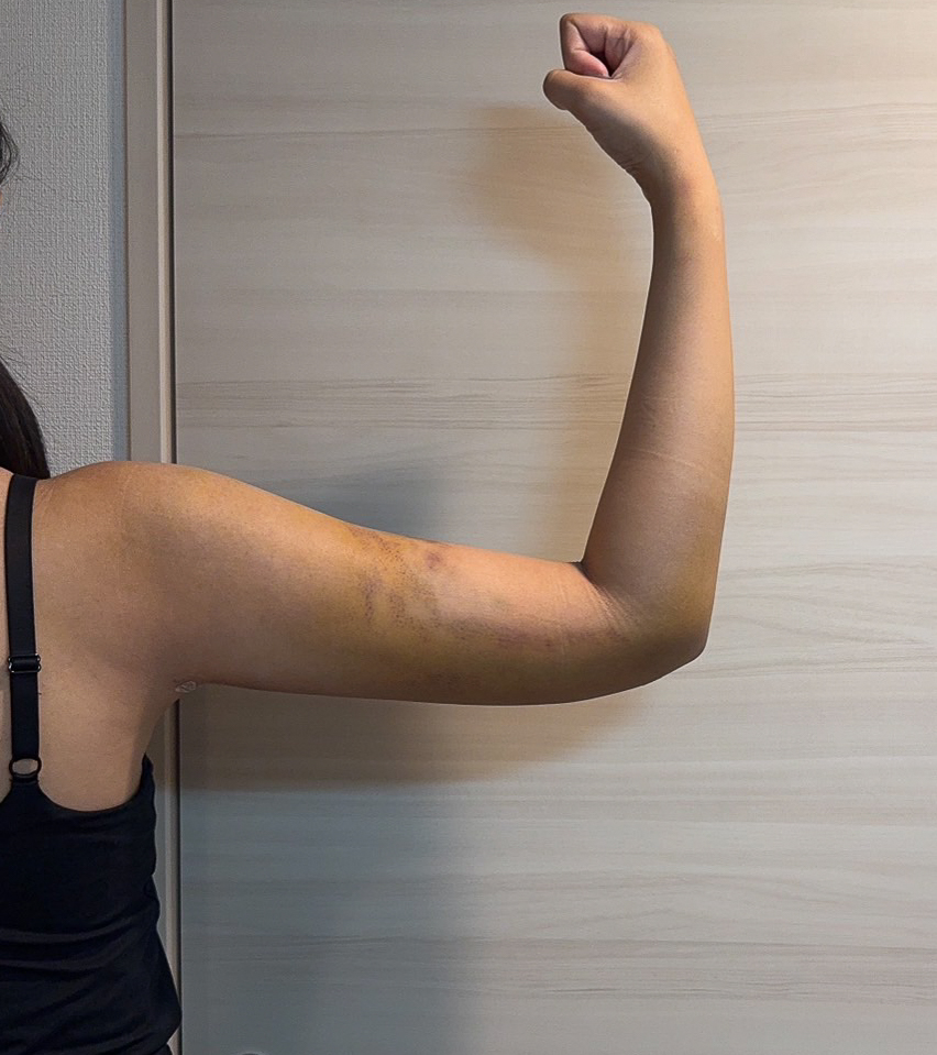 二の腕の脂肪吸引