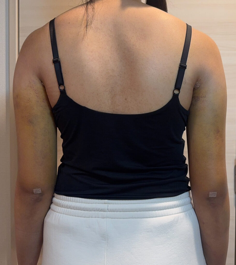 二の腕の脂肪吸引