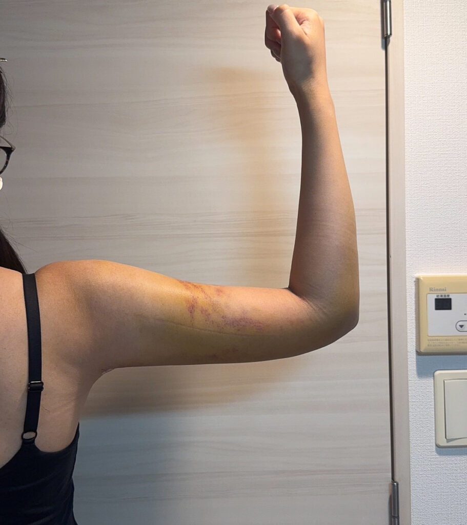 二の腕の脂肪吸引