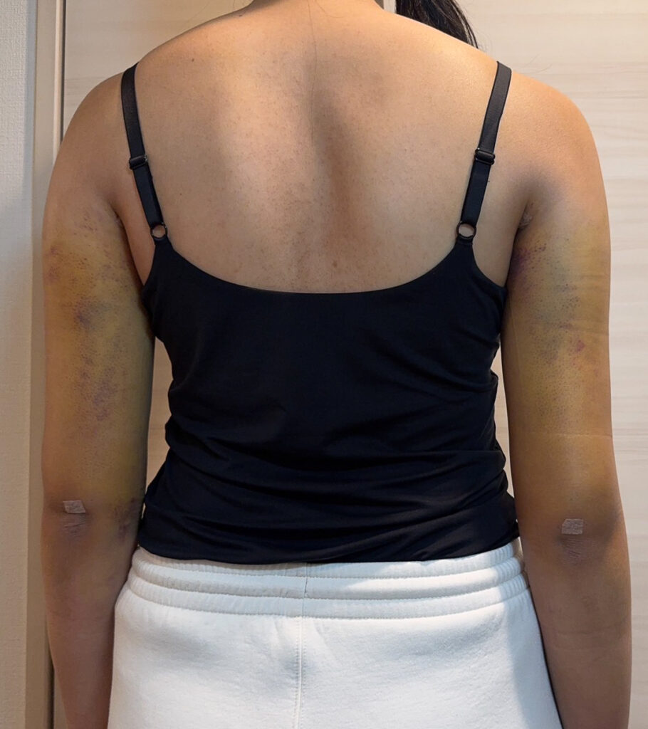 二の腕の脂肪吸引