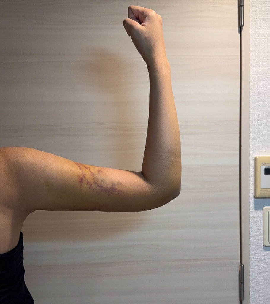 二の腕の脂肪吸引