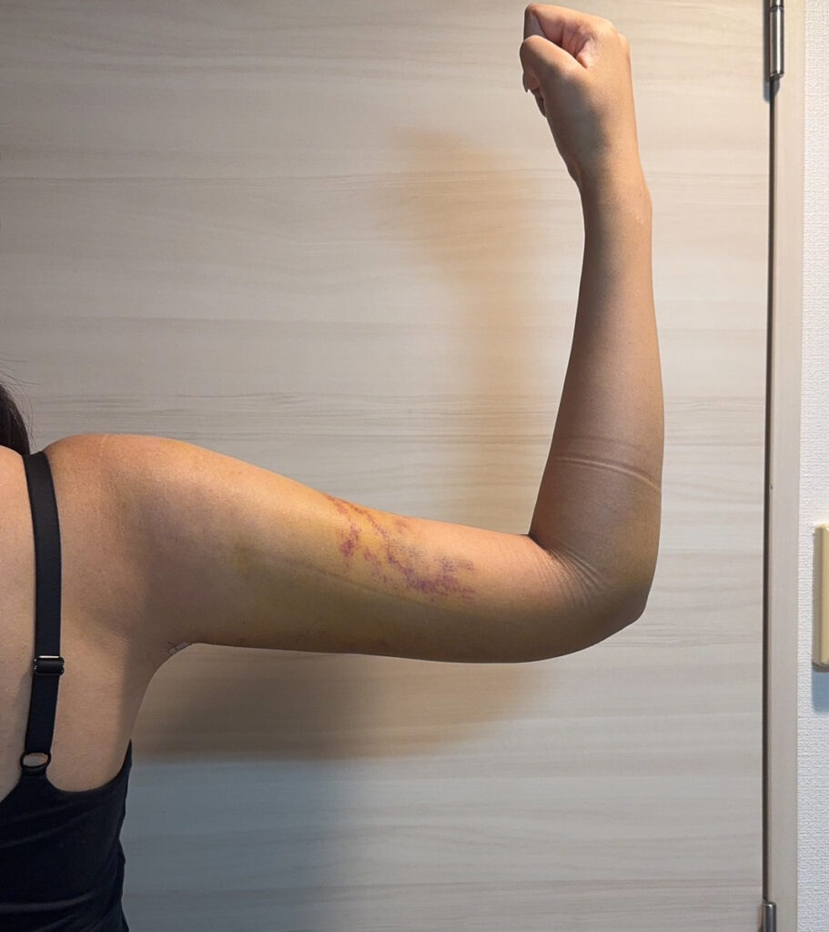 二の腕の脂肪吸引