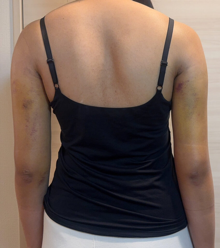 二の腕の脂肪吸引