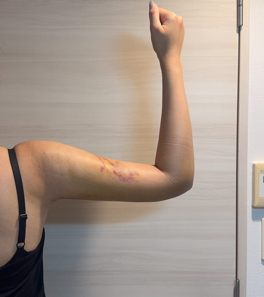 二の腕の脂肪吸引