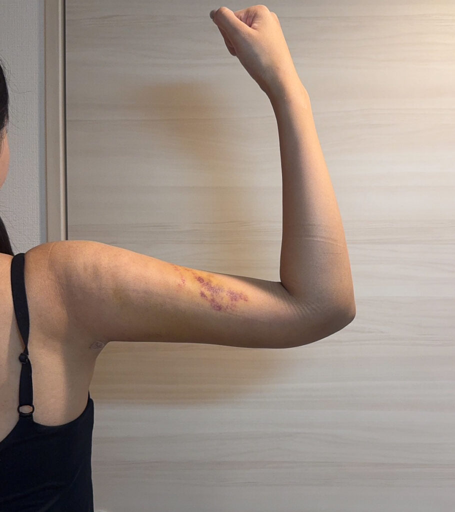 二の腕の脂肪吸引