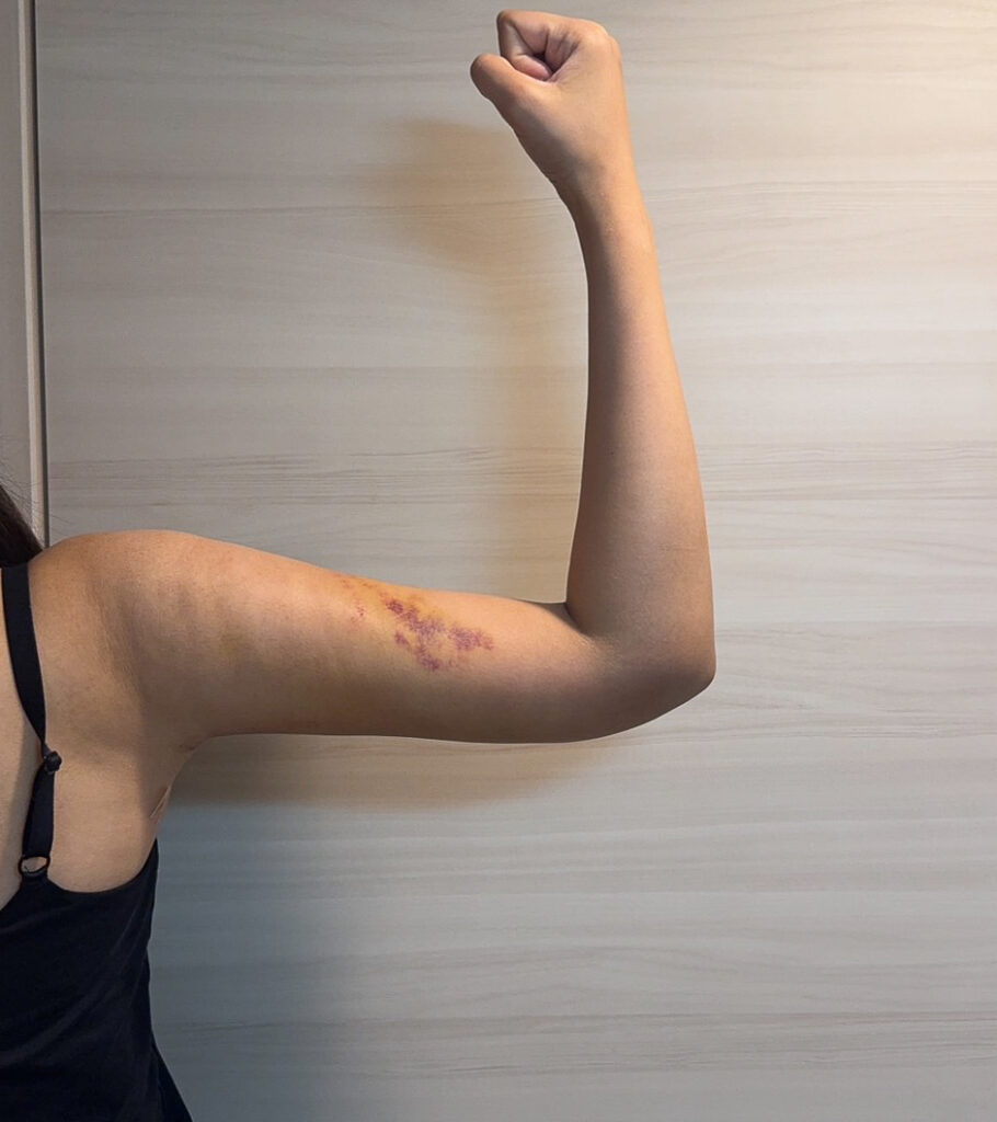 二の腕の脂肪吸引