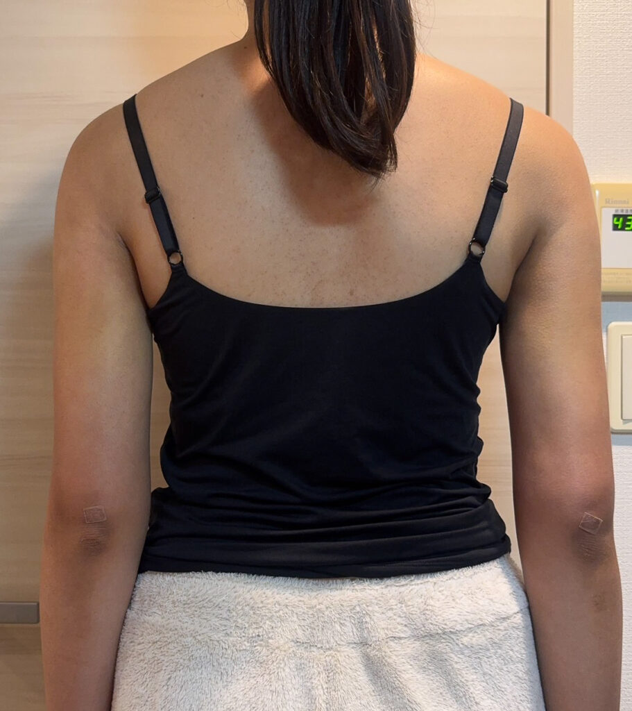 二の腕の脂肪吸引