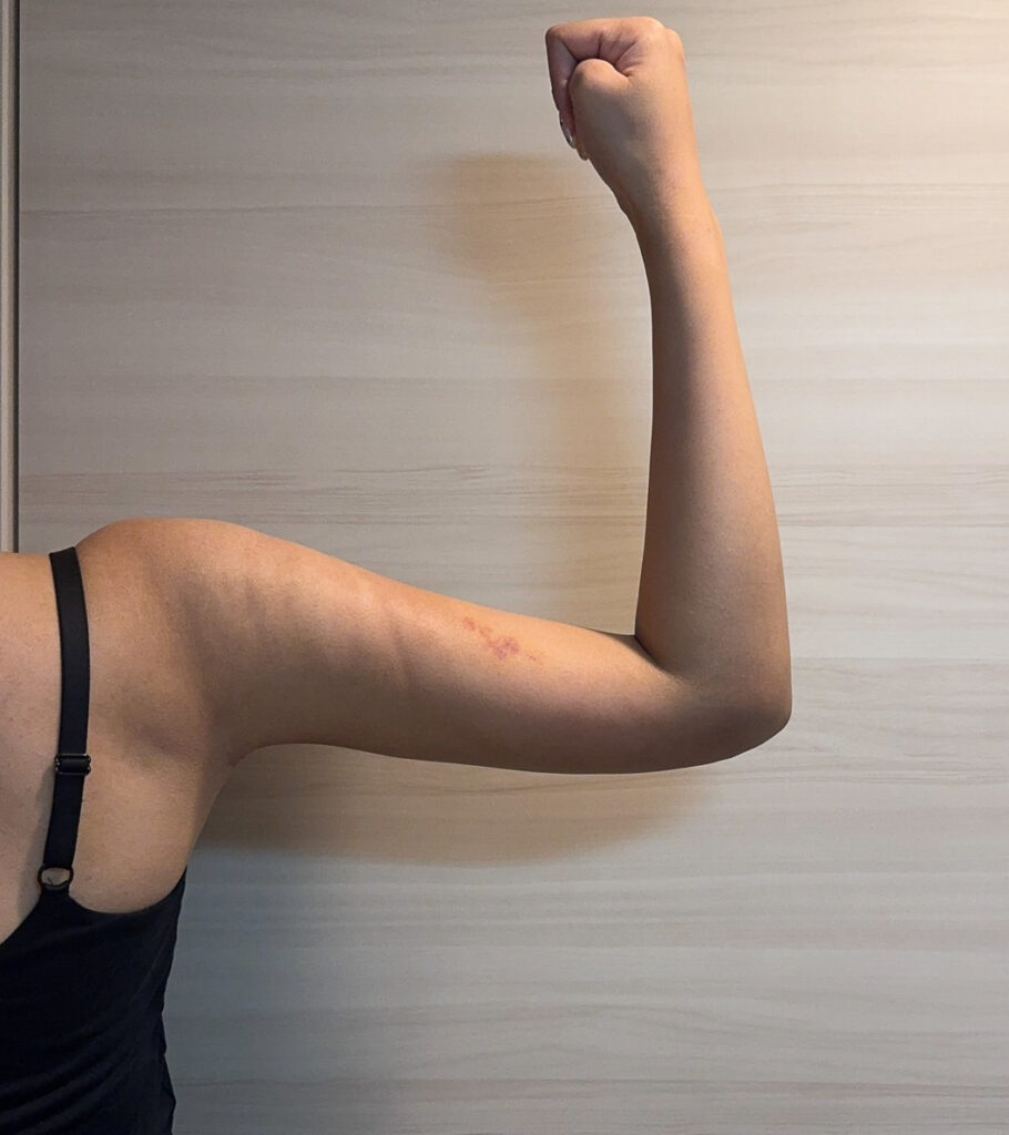 二の腕の脂肪吸引