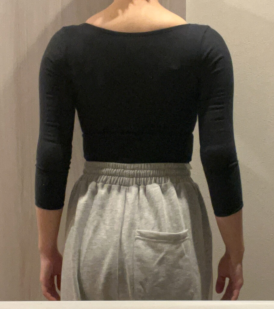 二の腕の脂肪吸引