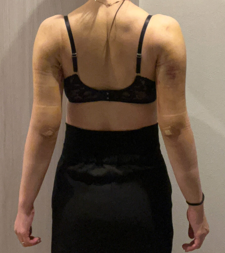 二の腕の脂肪吸引