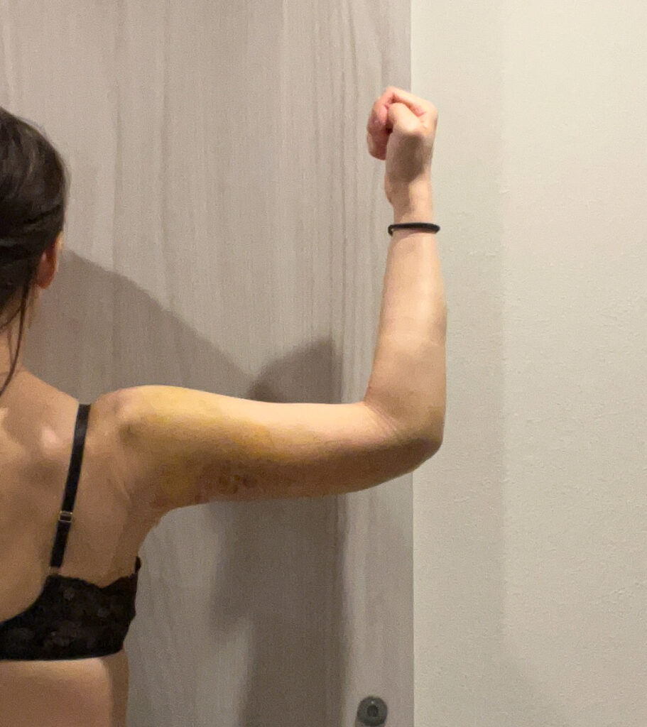 二の腕の脂肪吸引