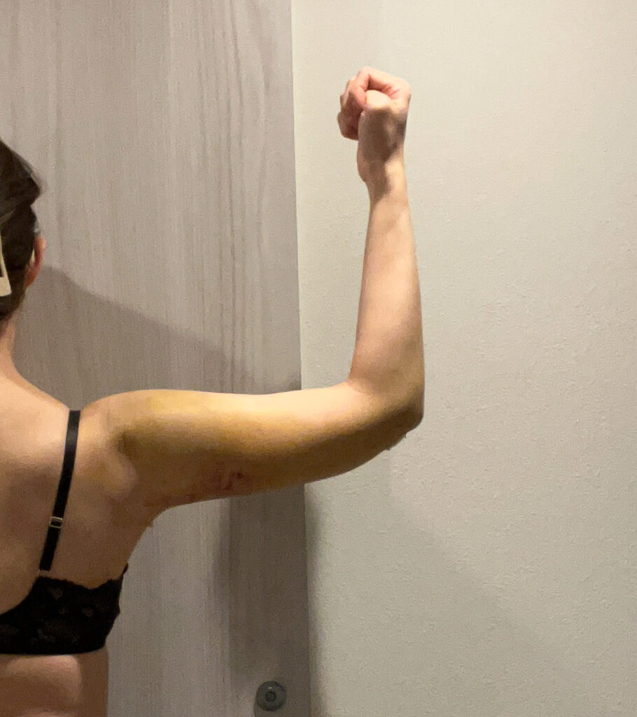 二の腕の脂肪吸引