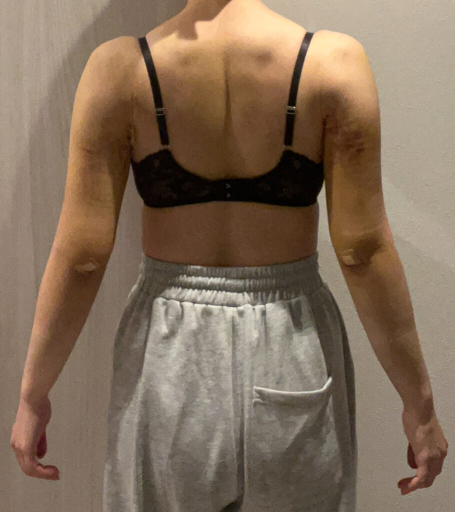 二の腕の脂肪吸引