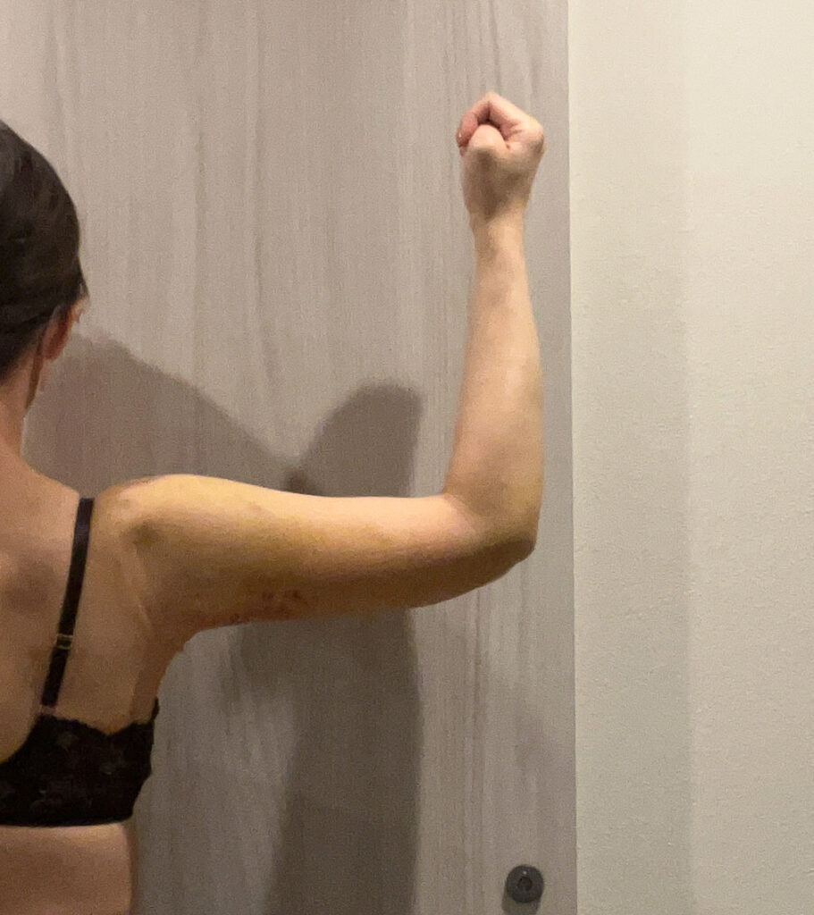 二の腕の脂肪吸引