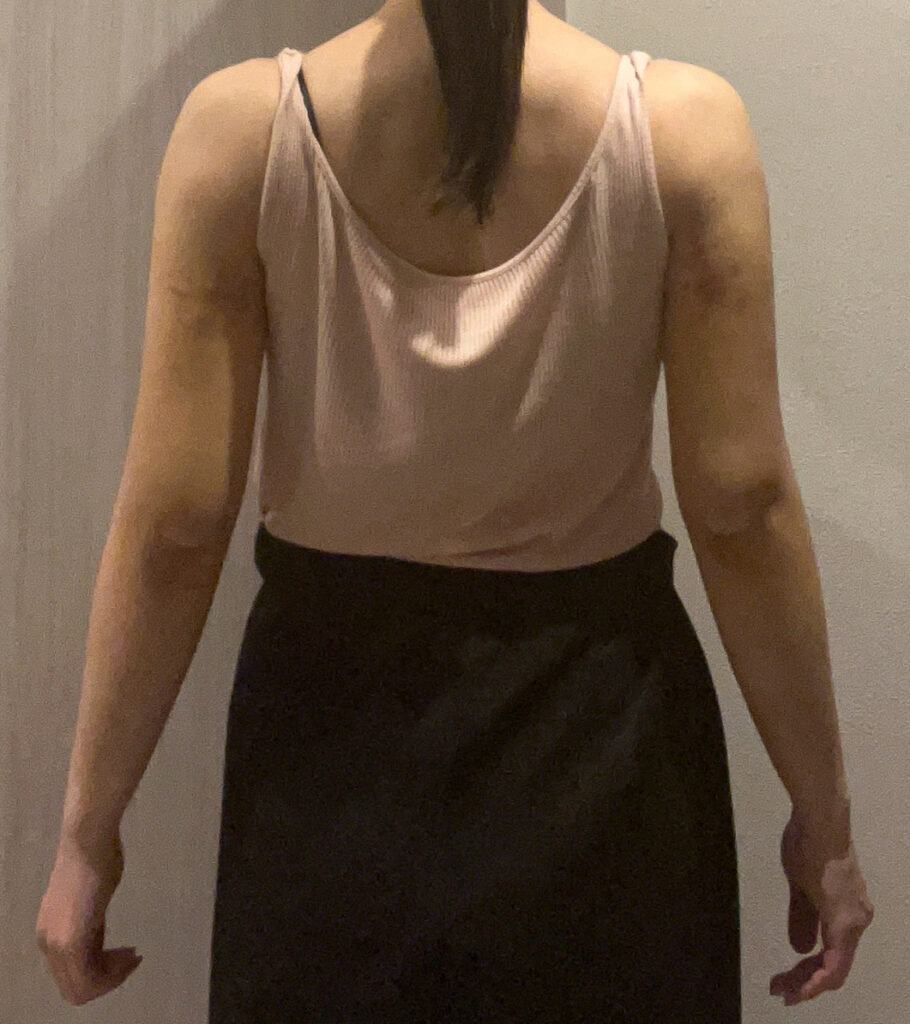 二の腕の脂肪吸引