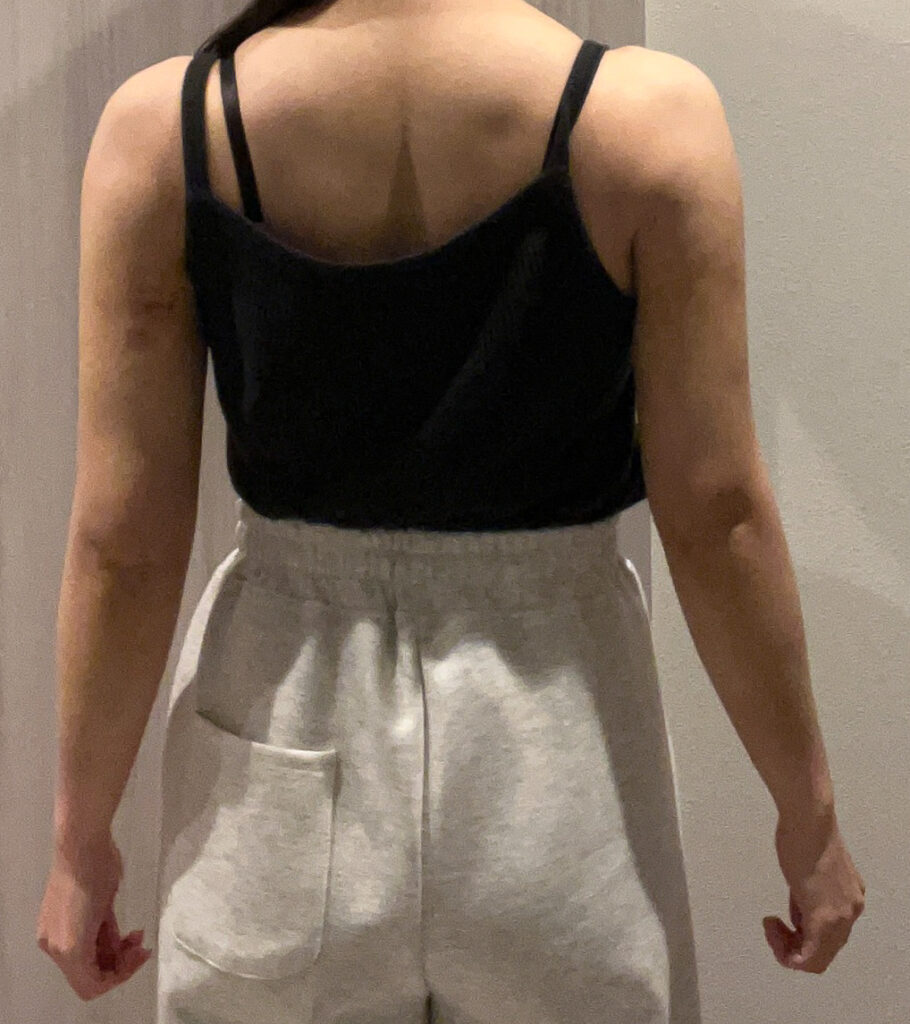 二の腕の脂肪吸引