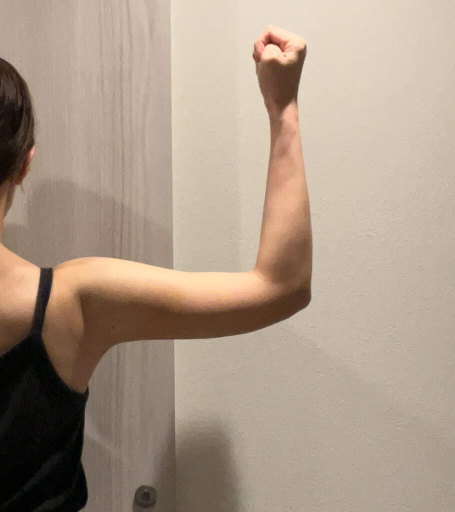 二の腕の脂肪吸引