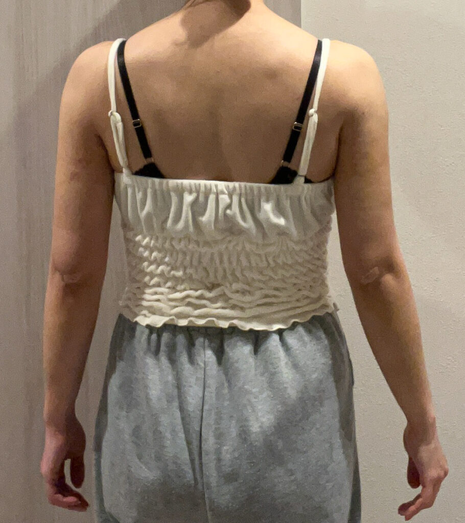 二の腕の脂肪吸引