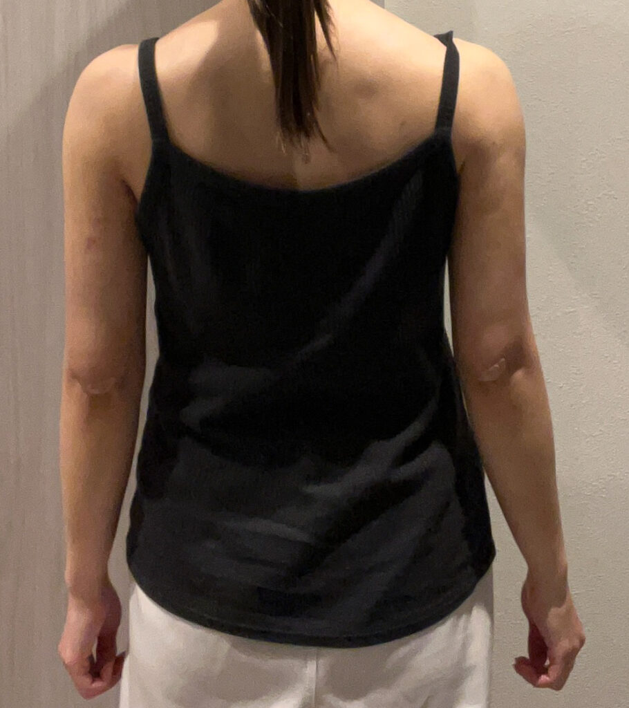 二の腕の脂肪吸引