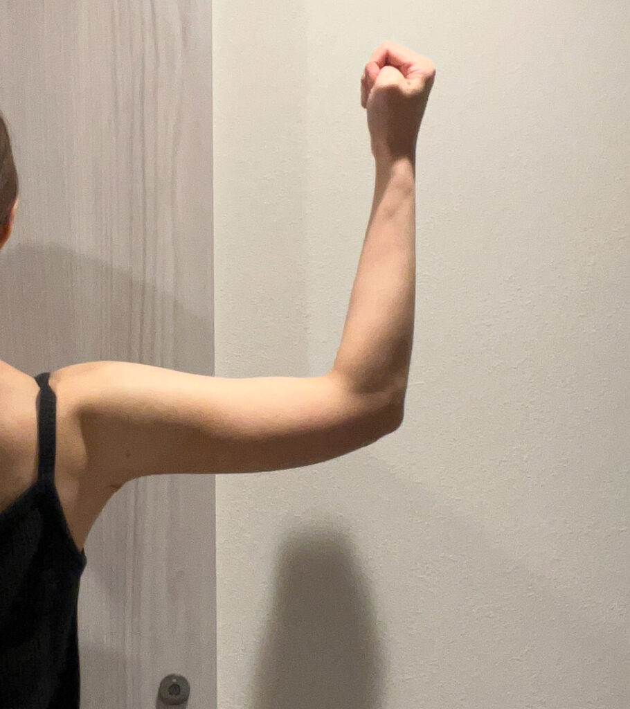 二の腕の脂肪吸引