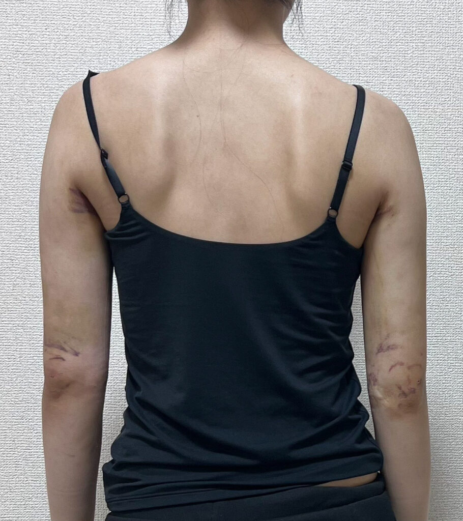 二の腕の脂肪吸引