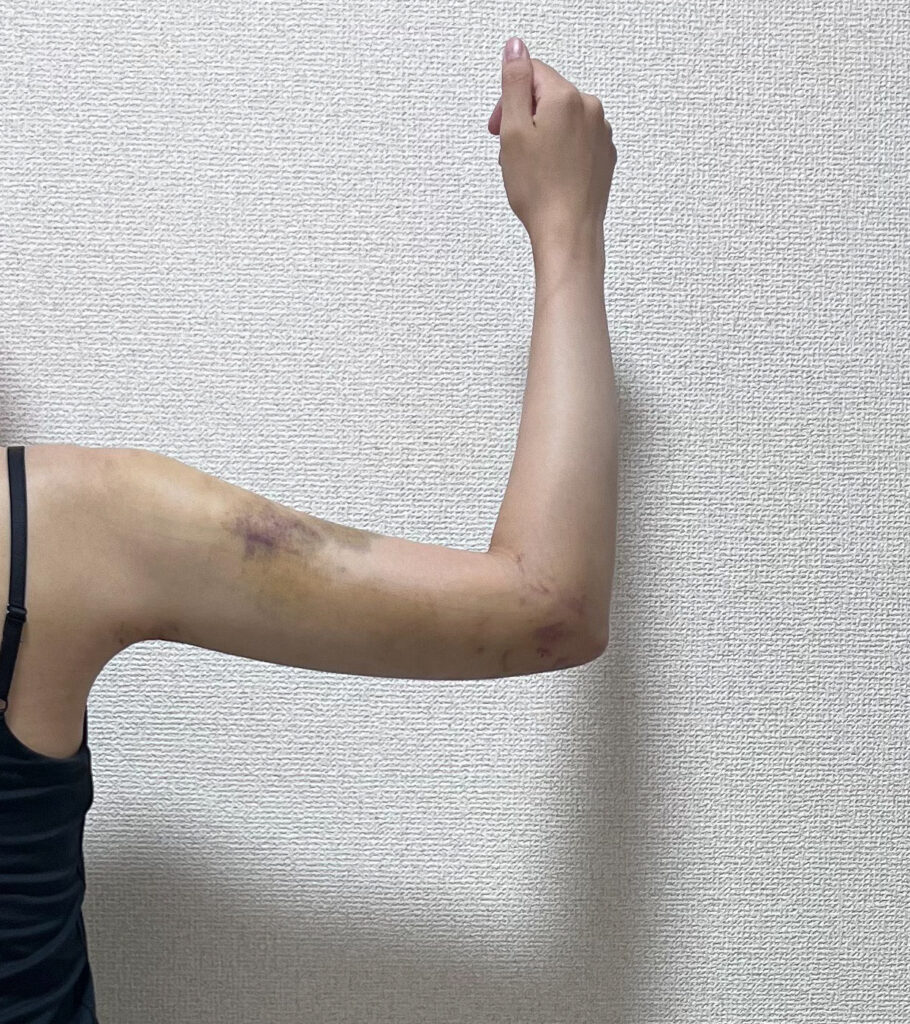二の腕の脂肪吸引