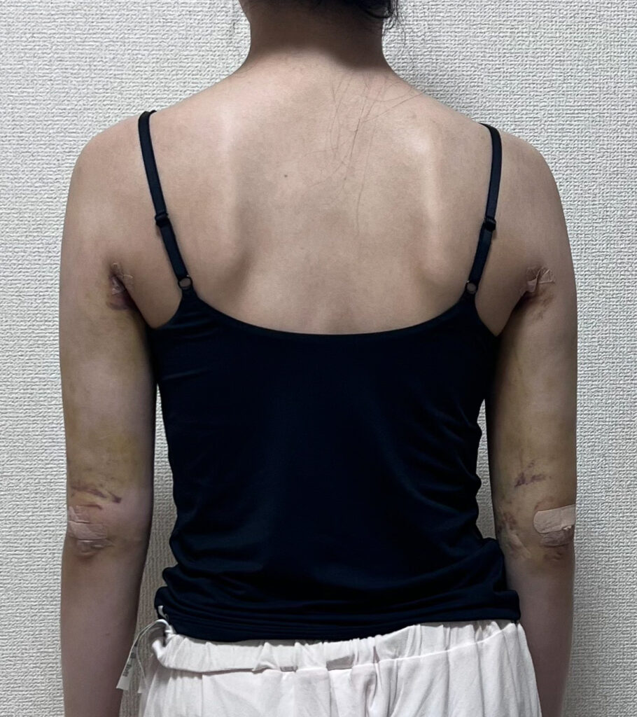 二の腕の脂肪吸引