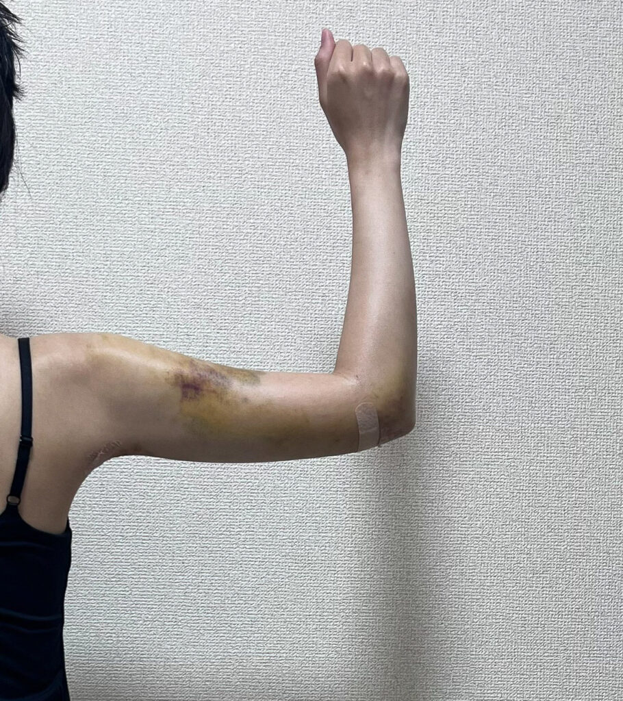 二の腕の脂肪吸引