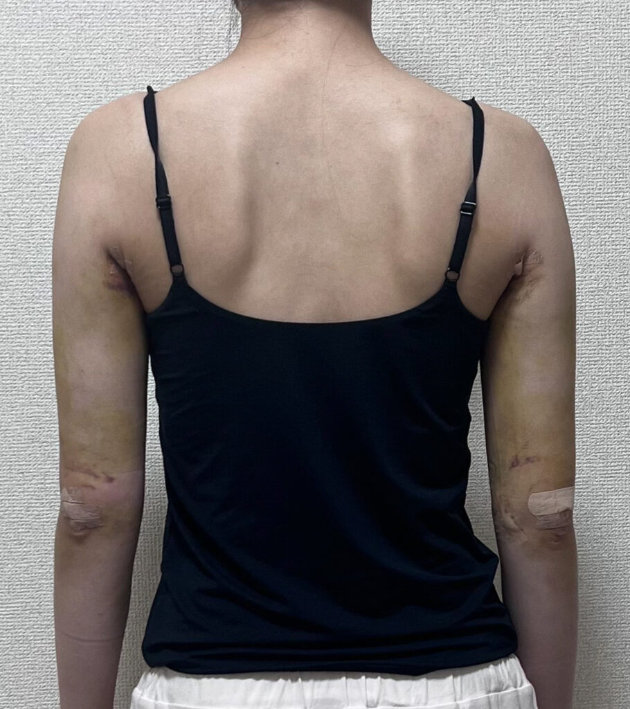 二の腕の脂肪吸引