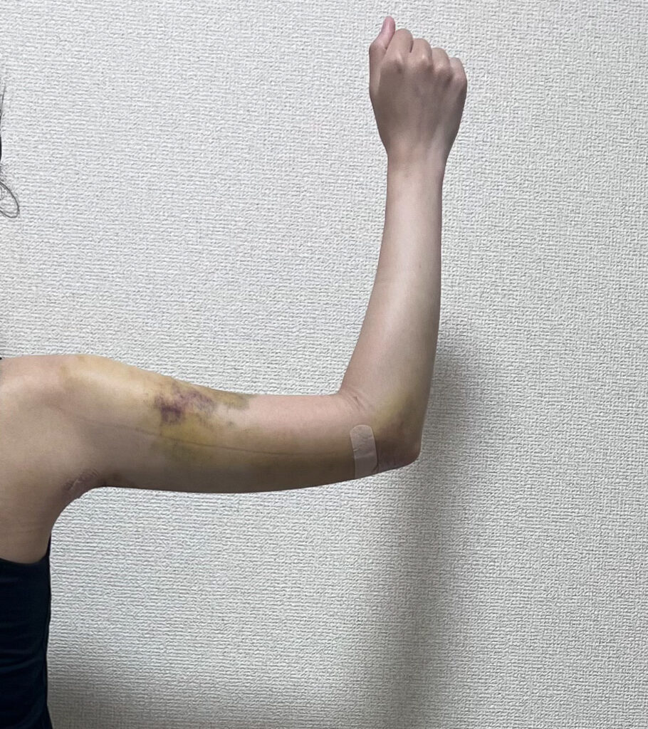 二の腕の脂肪吸引